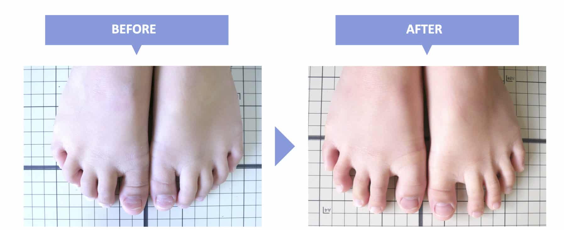 ハンマートゥの治し方完全ガイド！足指の変形と痛みを防ぐ改善策