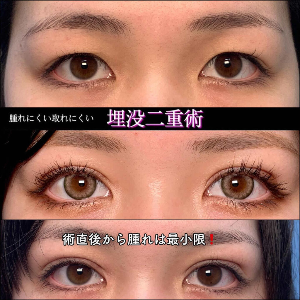 二重整形の失敗画像に潜む真実｜ハム目や左右差の元凶と修正の極意