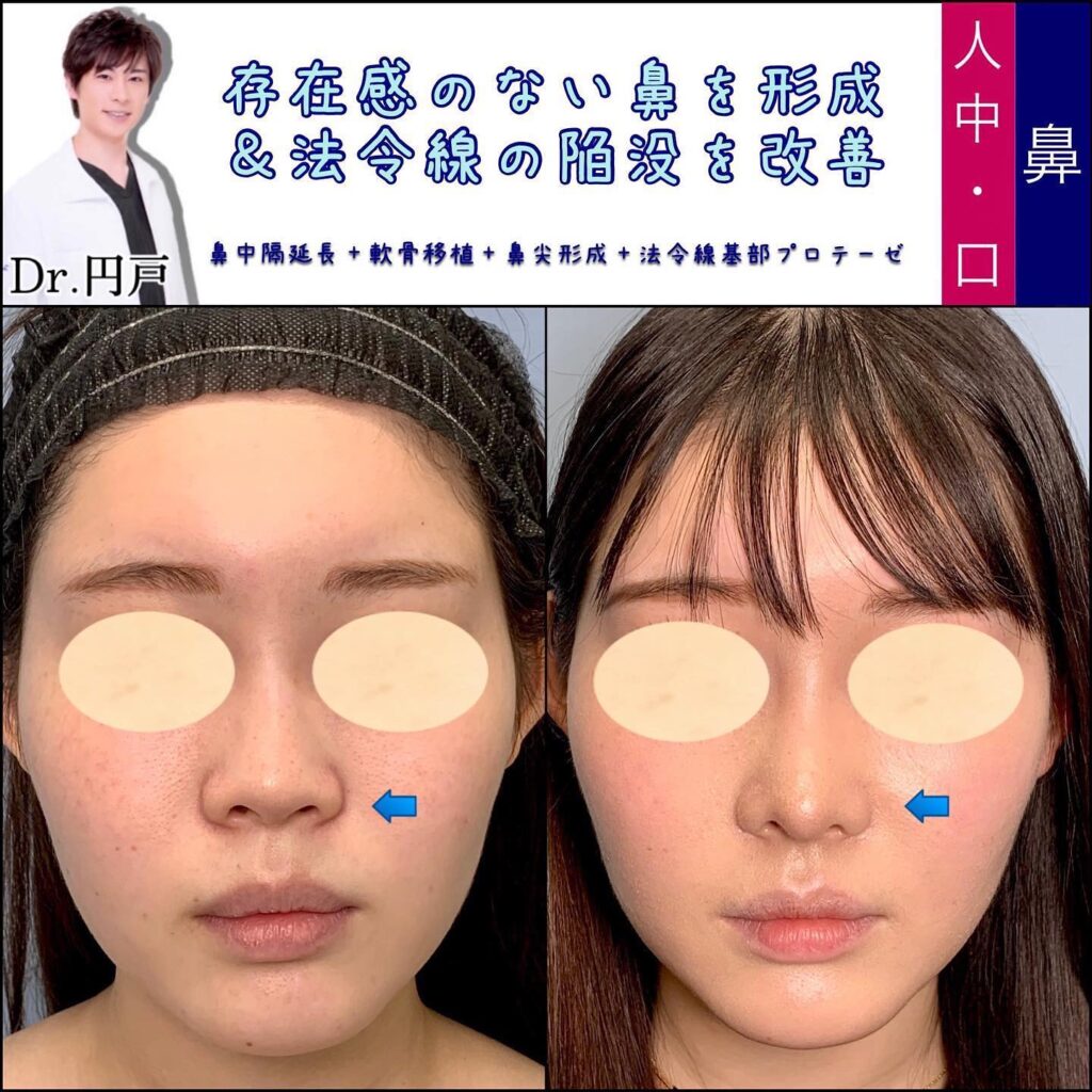 糸リフトのデメリットと後悔の真相｜ひきつれや失敗を防ぐ全知識