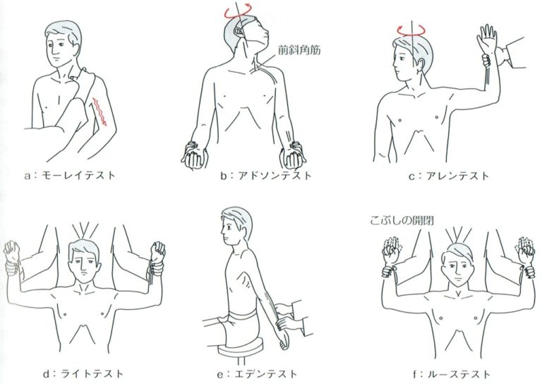 手のしびれは胸郭出口症候群？自宅テストのやり方と陽性サインを解説