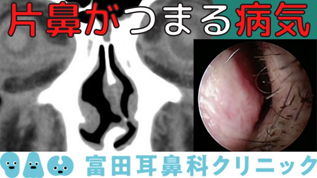 鼻づまりで両方息ができない夜の正体｜即効解消法と2026年最新治療