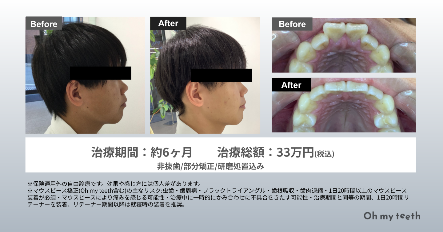 歯列矯正で顔の変化はどこまで起きる？写真比較と劇的改善の真相
