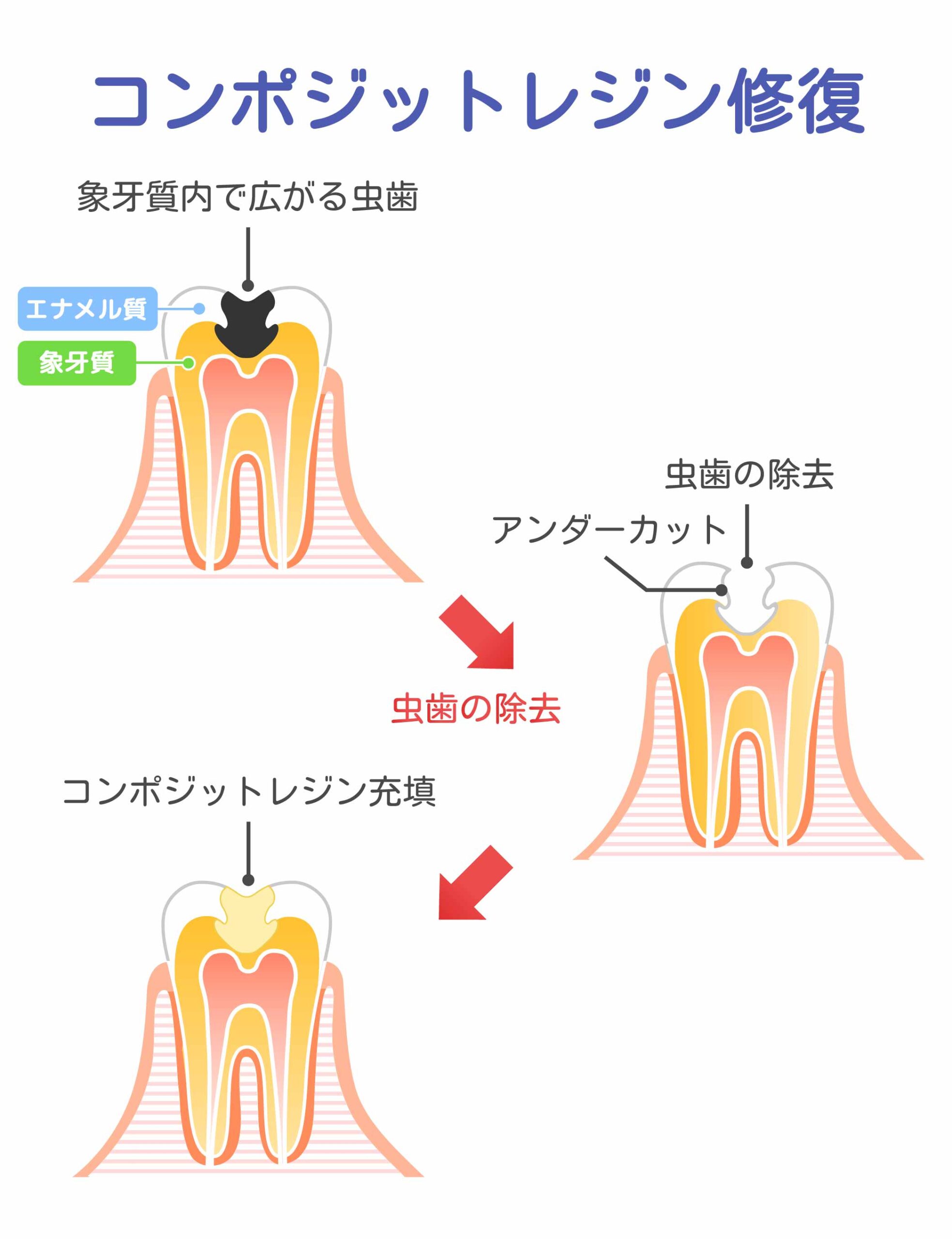 歯科のレジンとは？保険適用の費用や銀歯・セラミックとの違いを解説
