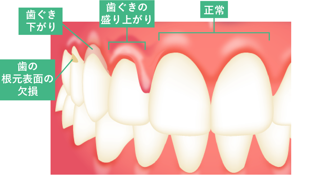 歯磨きしすぎが招く歯の崩壊！知覚過敏と歯茎後退の真相