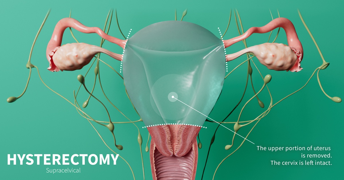 How Long After Hysterectomy Can You Have Intercourse