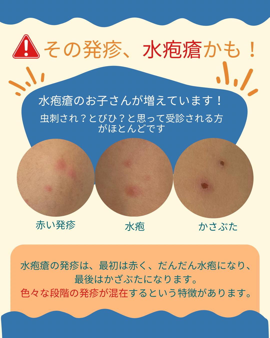 水疱瘡で水泡にならない？不全型水痘の写真と見分け方を解説【2026】