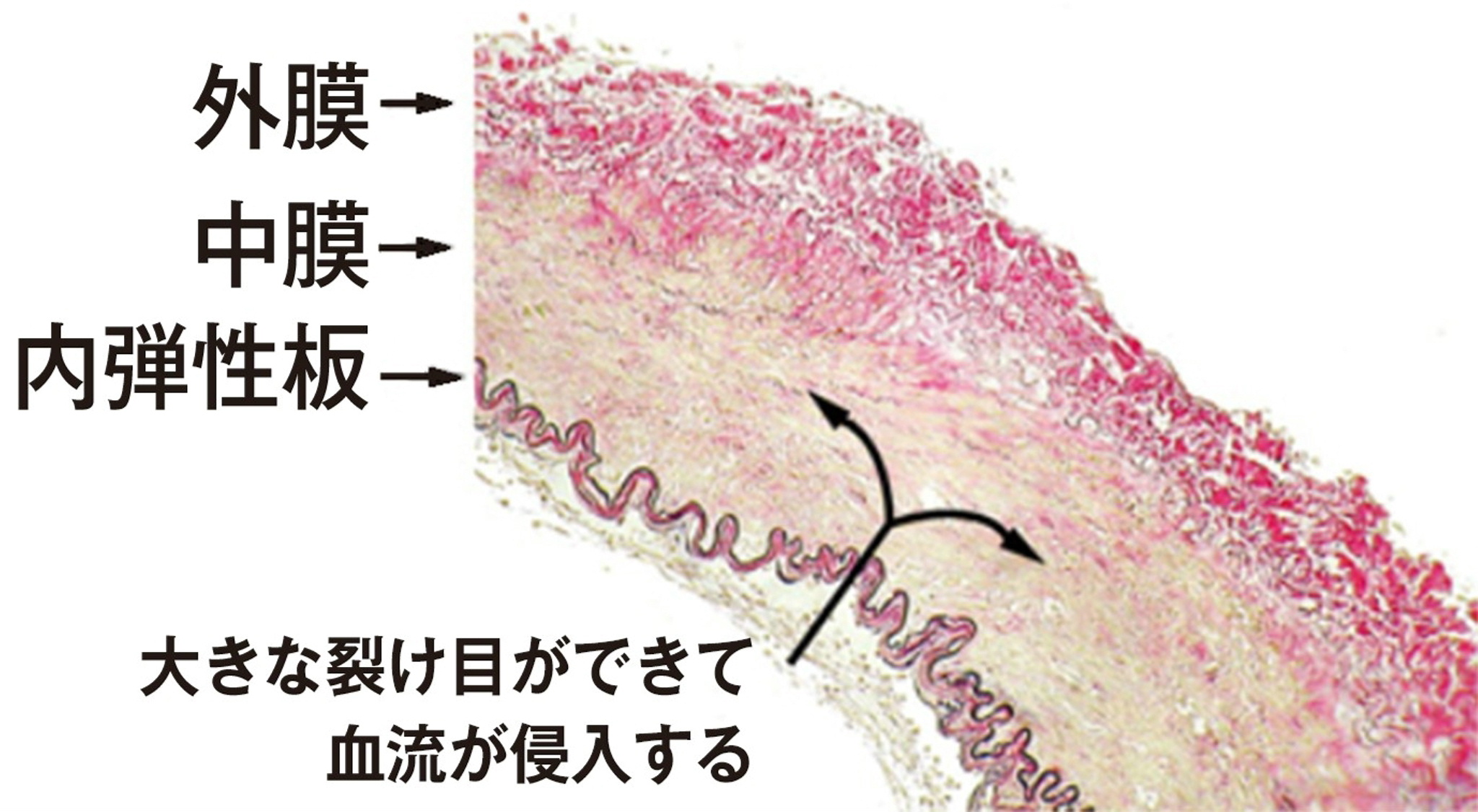 首の骨を鳴らすリスクと脳梗塞の真相！ポキポキ音の正体と安全な改善策