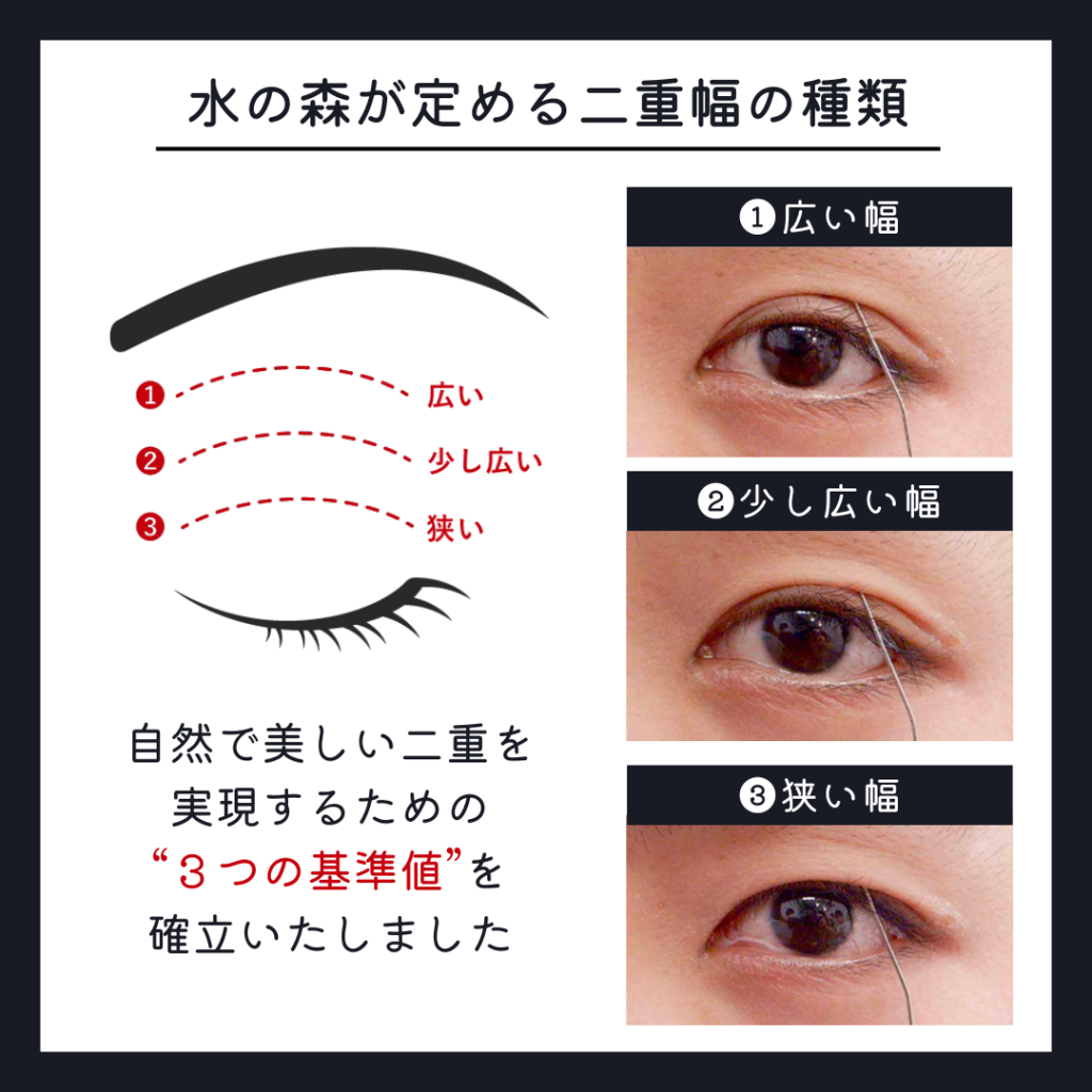 埋没で二重幅が広すぎて失敗？腫れとハム目の違いや抜糸修正の真相