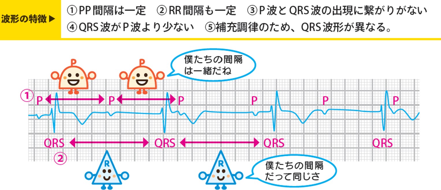 完全房室ブロックの症状と原因｜失神や突然死を防ぐペースメーカー治療の真実