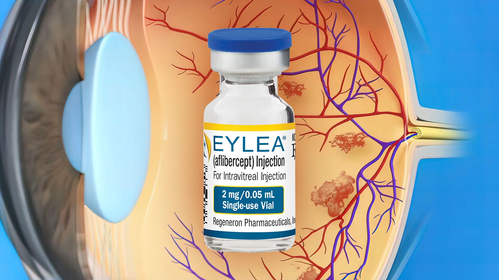 Anti Vegf Injections for Macular Degeneration