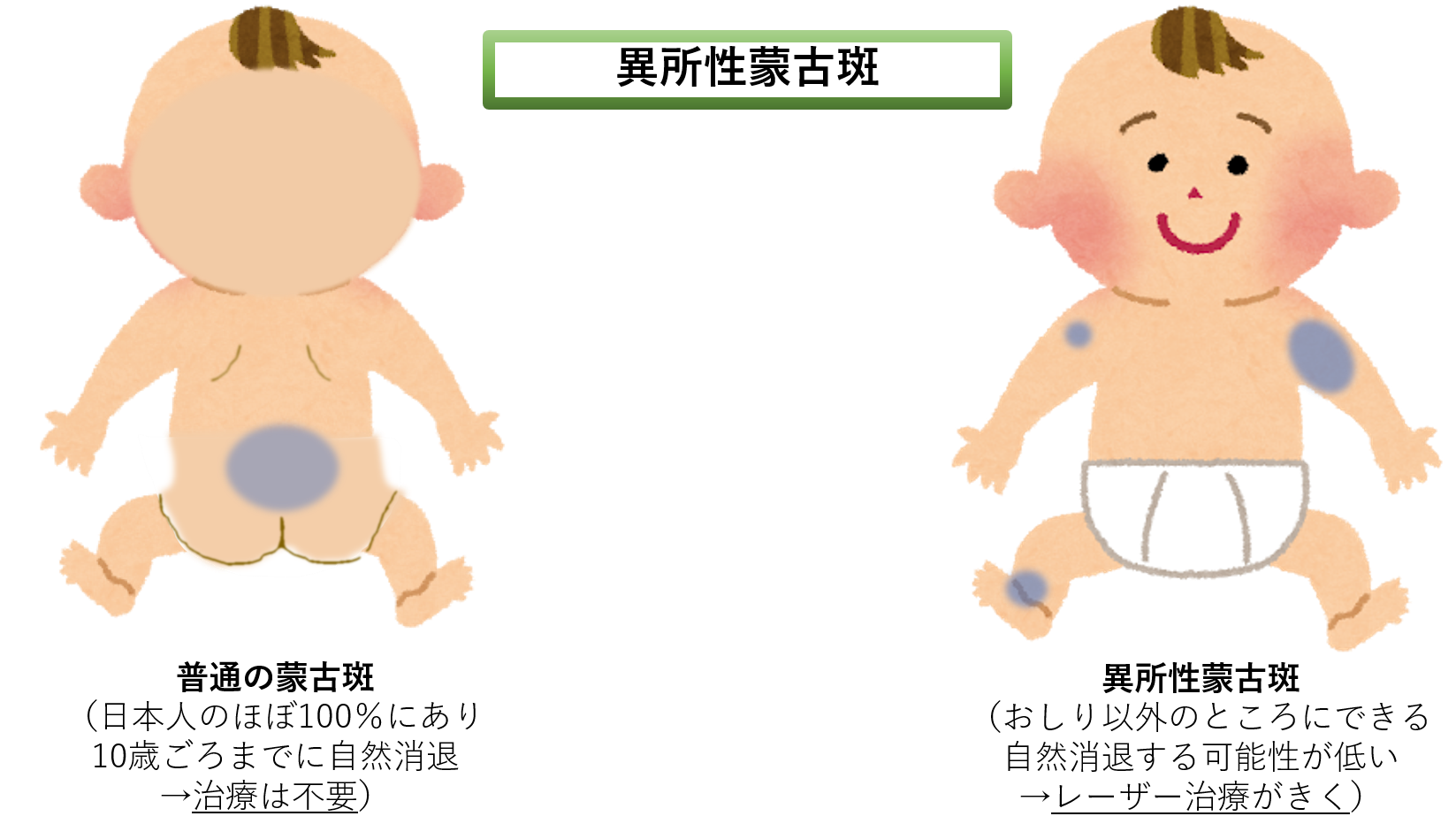 赤ちゃんの蒙古斑とは？消える時期や原因・異所性蒙古斑の治療を徹底解説