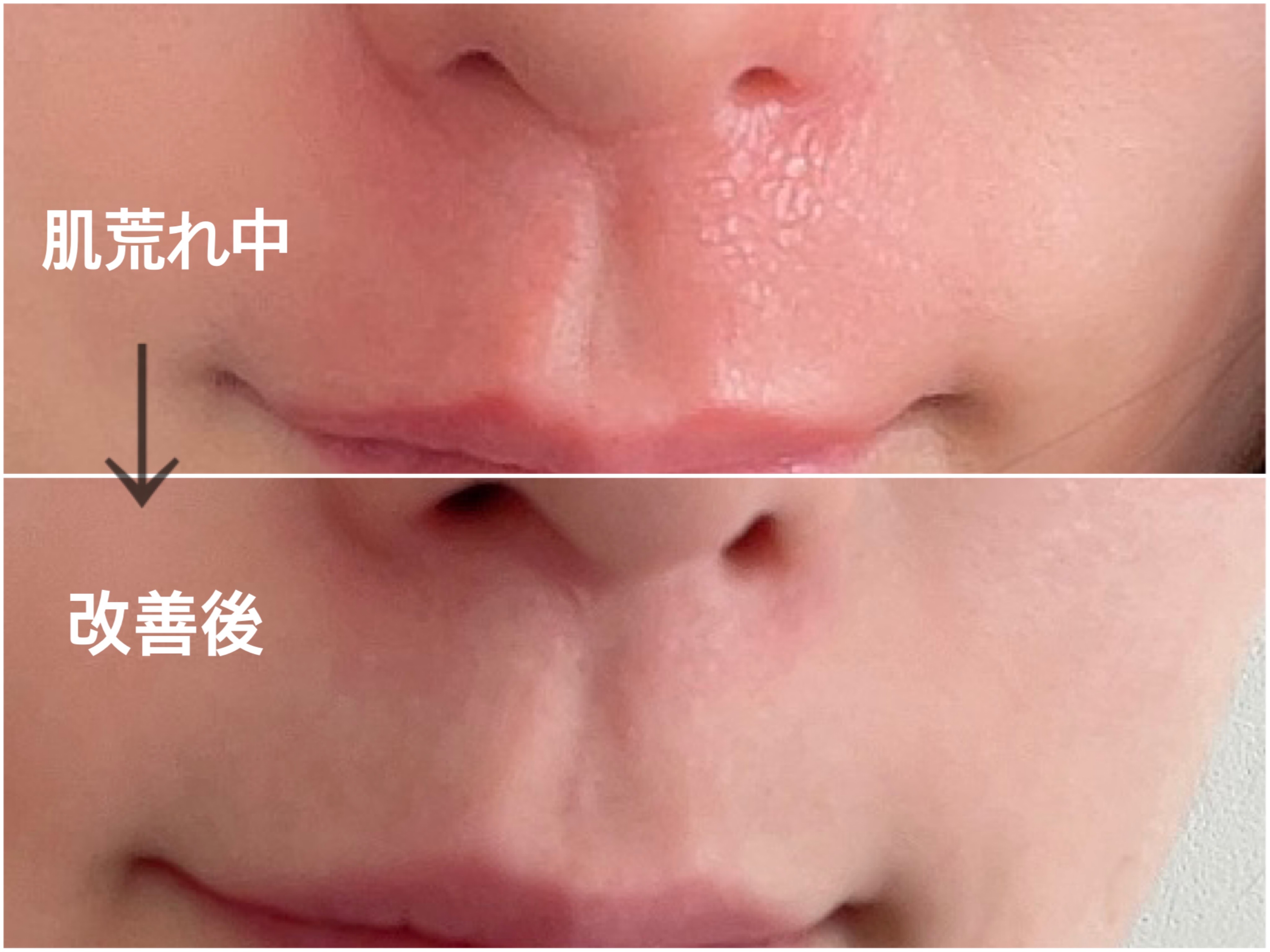 鼻をかみすぎて痛い原因と即効対処法！赤み・皮むけ・鼻前庭炎の治し方