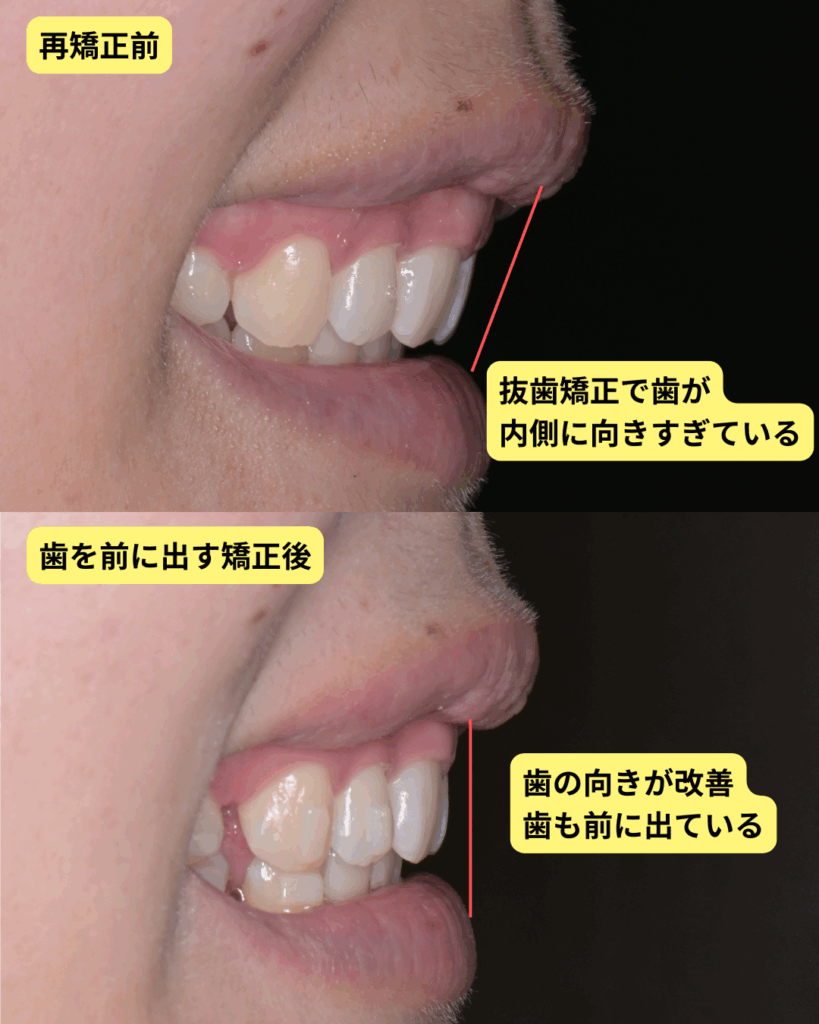抜歯矯正で口元が引っ込みすぎ？老け顔の原因と2026年最新治療策