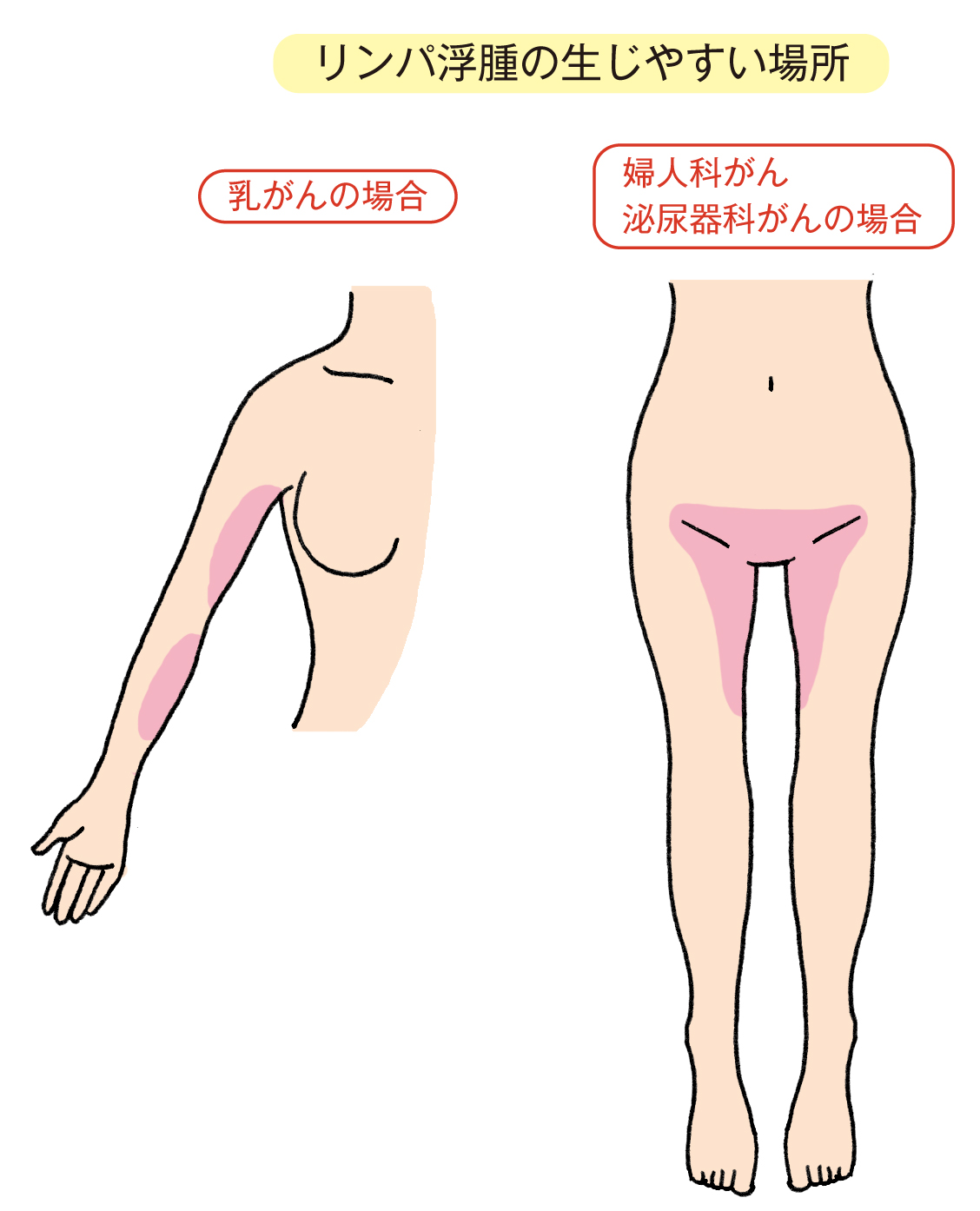 乳がん術後｢腕の異変｣を放置してはいけない決定的理由 リンパ浮腫の最新予防策と費用･体験談から紐解く2026年の正解