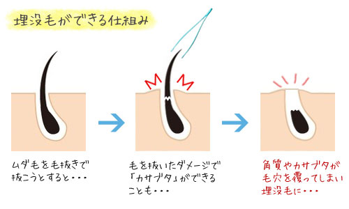 金玉のセルフ除毛に潜む罠！皮膚科医が教える痛くないVio医療脱毛