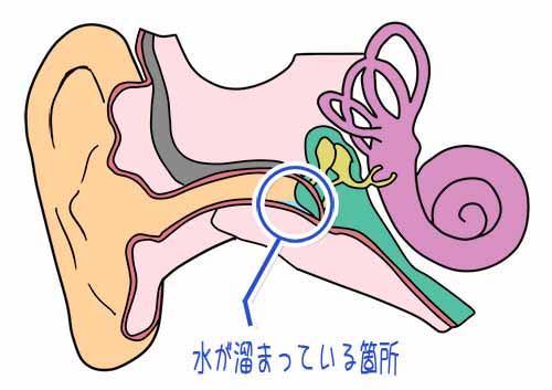 【2026年最新】耳に水が入った・取れない時の即効対処法！綿棒はNg？耳鼻科医が明かす安全な抜き方とNg行動