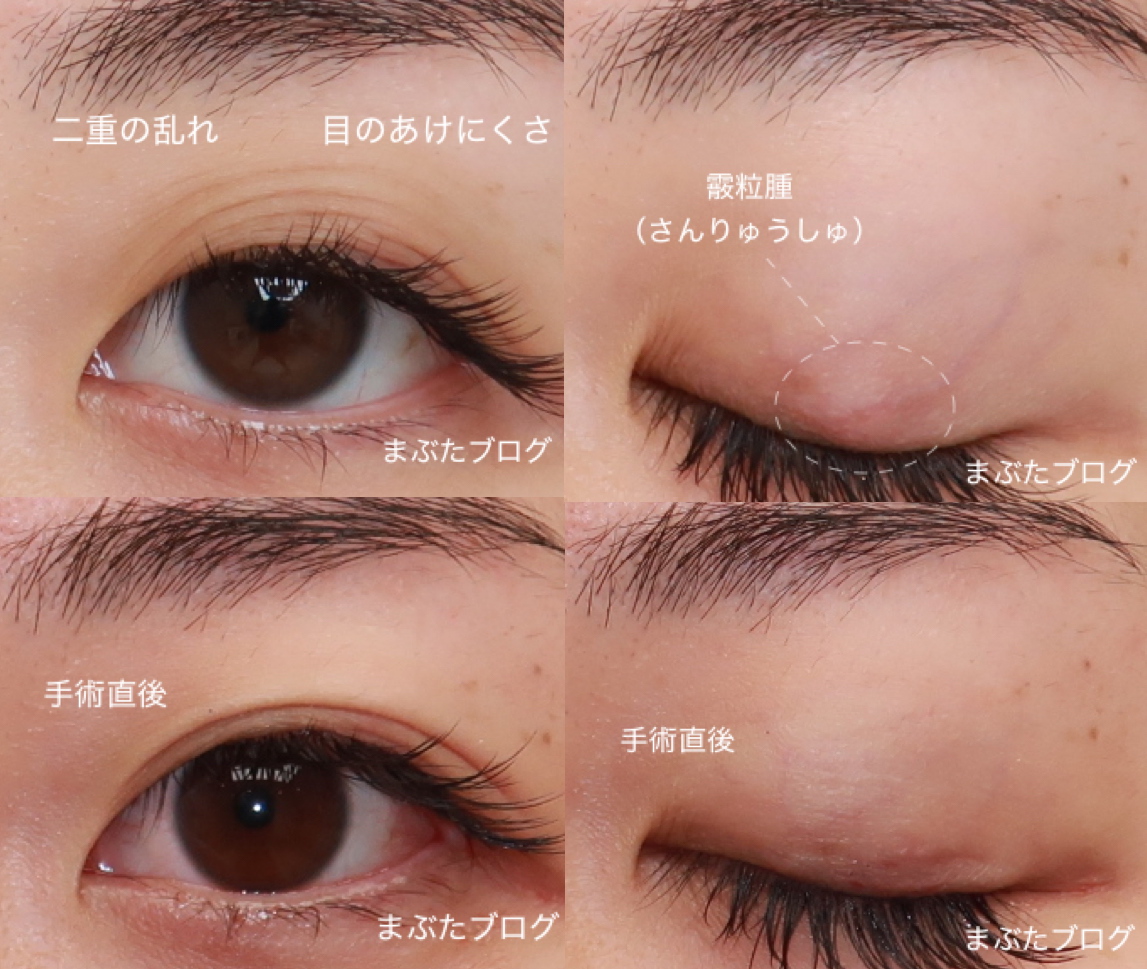 霰粒腫手術のリアル体験談！局所麻酔の痛みと腫れ・費用の真相