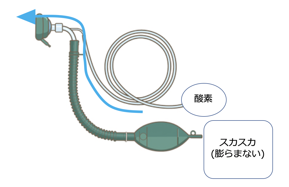 命を繋ぐジャクソンリース回路の手技と落とし穴！小児麻酔の最前線