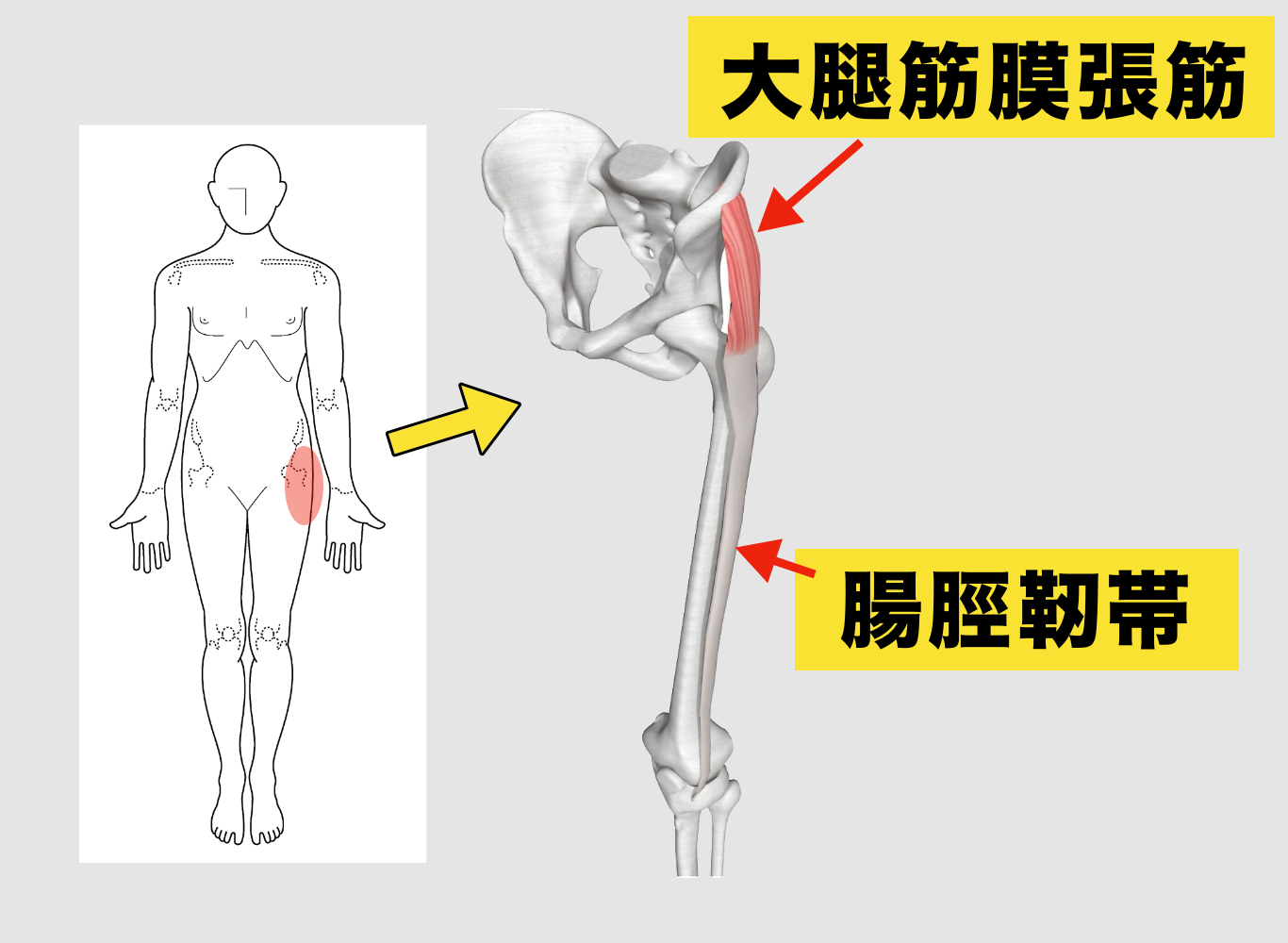 大腿筋膜張筋の張り・痛みの真相｜太もも外側の違和感を即リセット