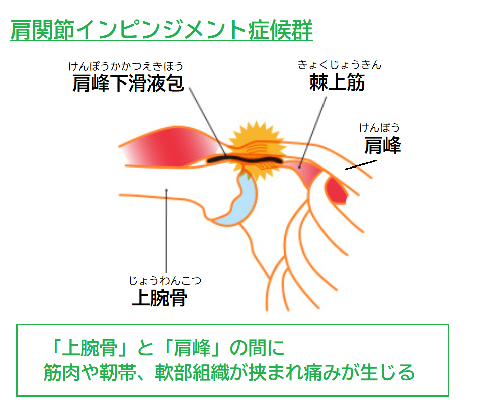 筋トレで肩が痛い原因と治し方！インピンジメントや腱板損傷の予防法