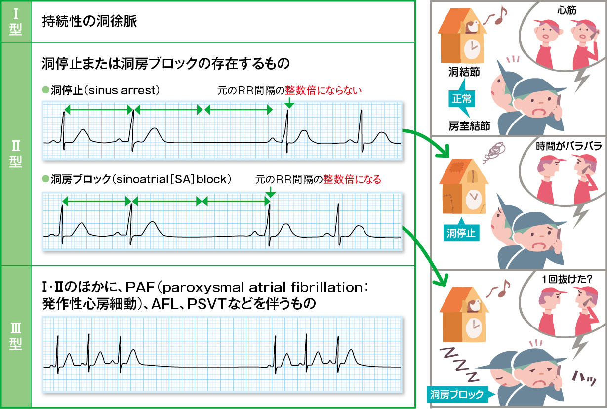 洞不全症候群の心電図を見抜く！分類別の波形とペースメーカー適応