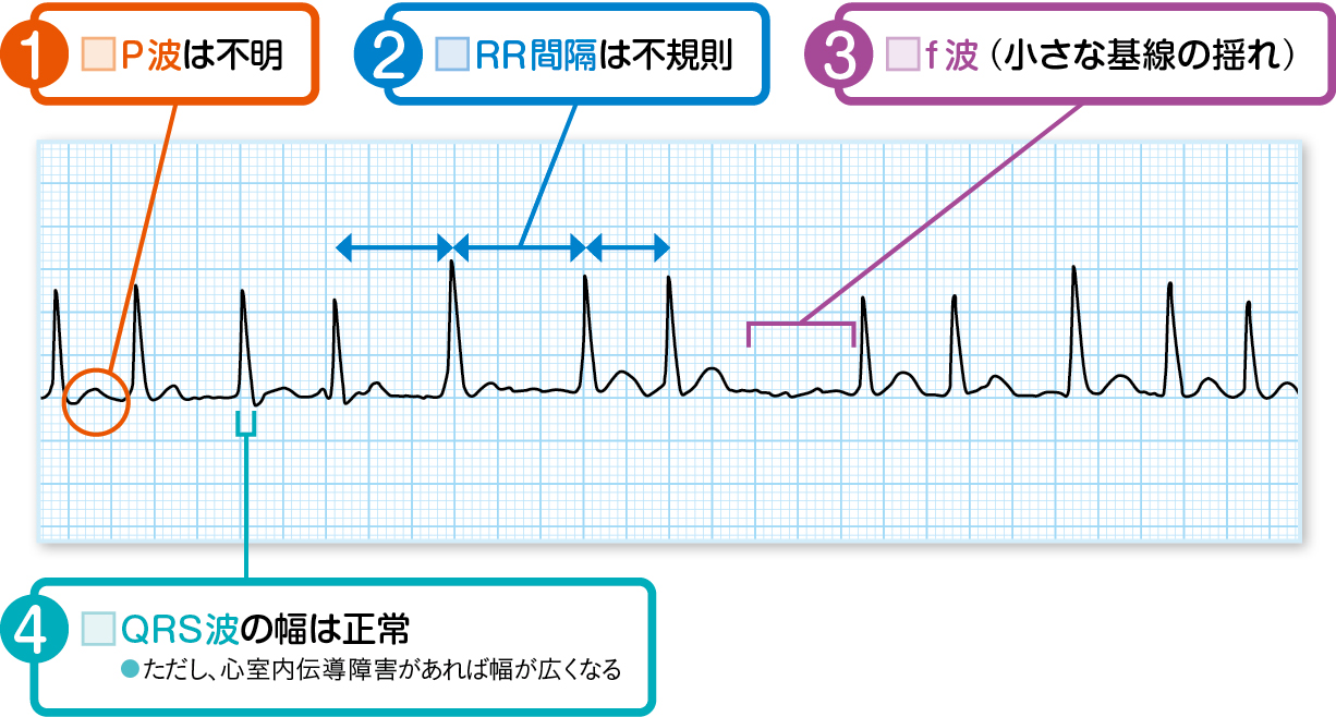 心房細動の心電図波形を見抜く！P波消失とRr不整の危険サイン