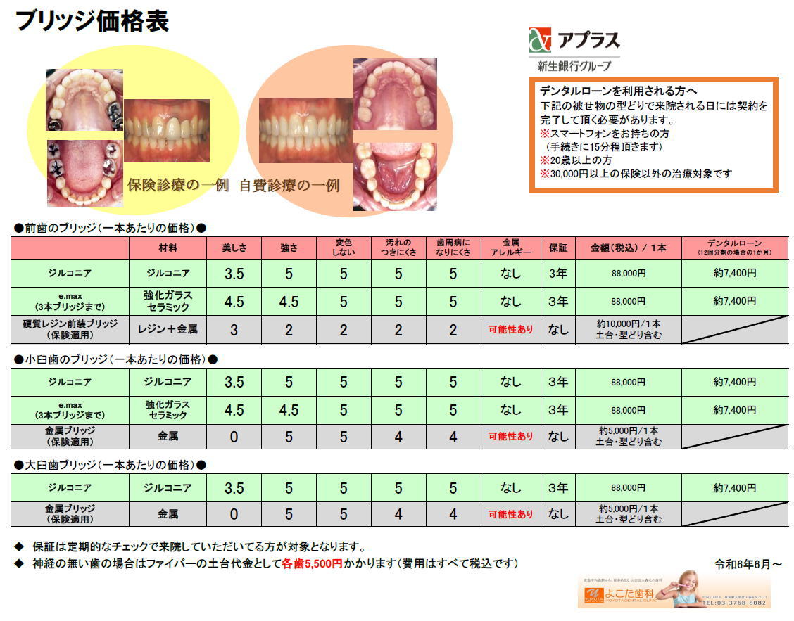保険適用で白い歯のブリッジは実際いくら？2026年最新料金表と奥歯の条件を徹底解説