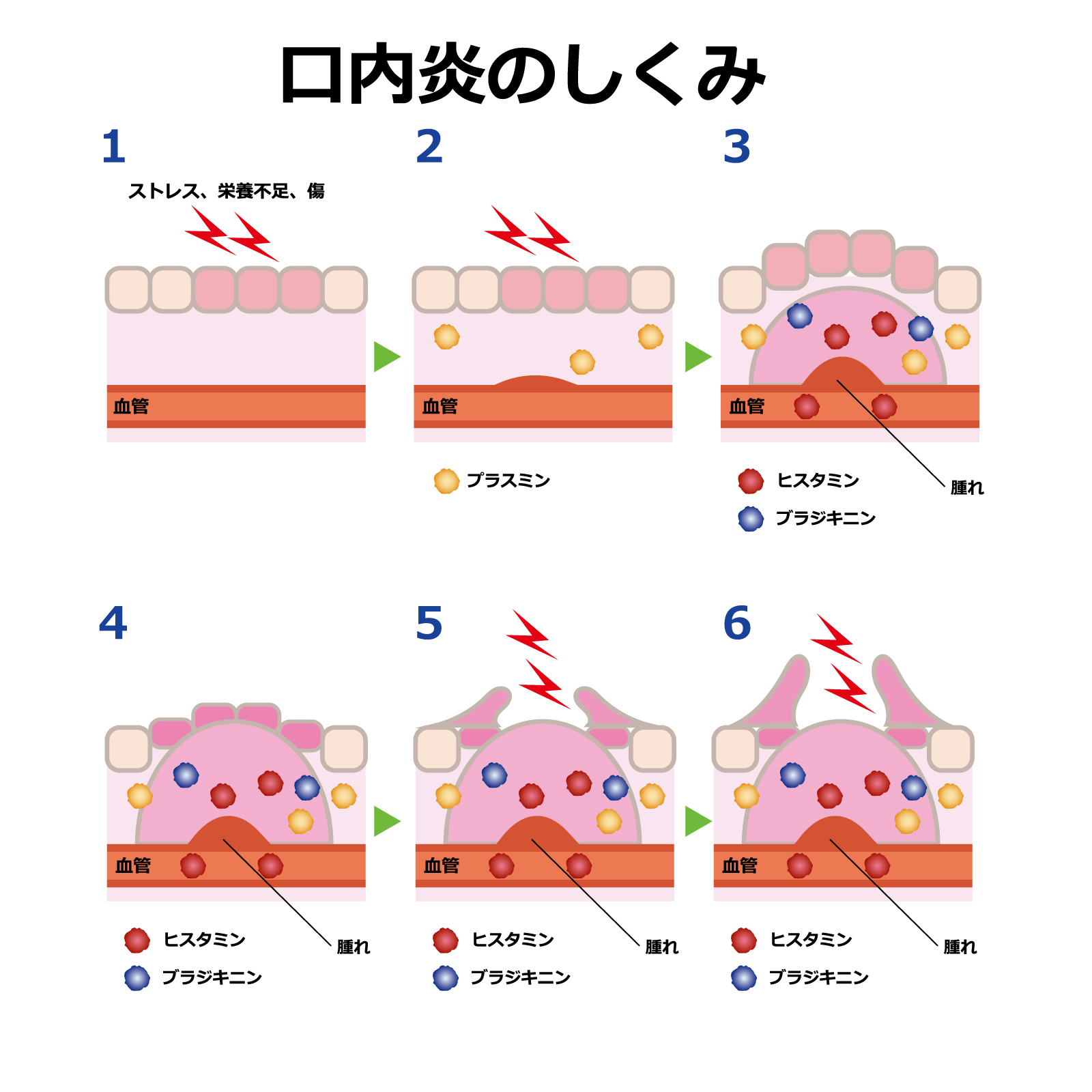 【2026年最新】痛い口内炎を1日で撃退？ネットで話題の「裏ワザ」と医学的に正しい即効ケア徹底検証