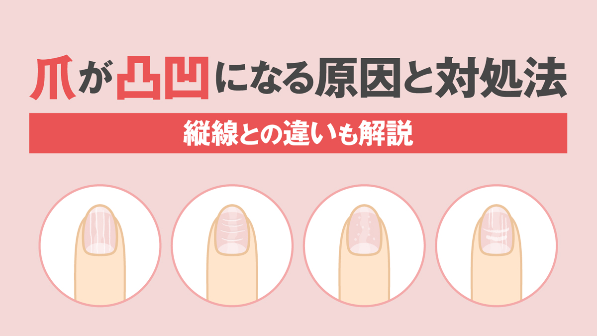 爪の表面が凸凹する原因は病気？縦線・横線の見分け方と最新改善ケア