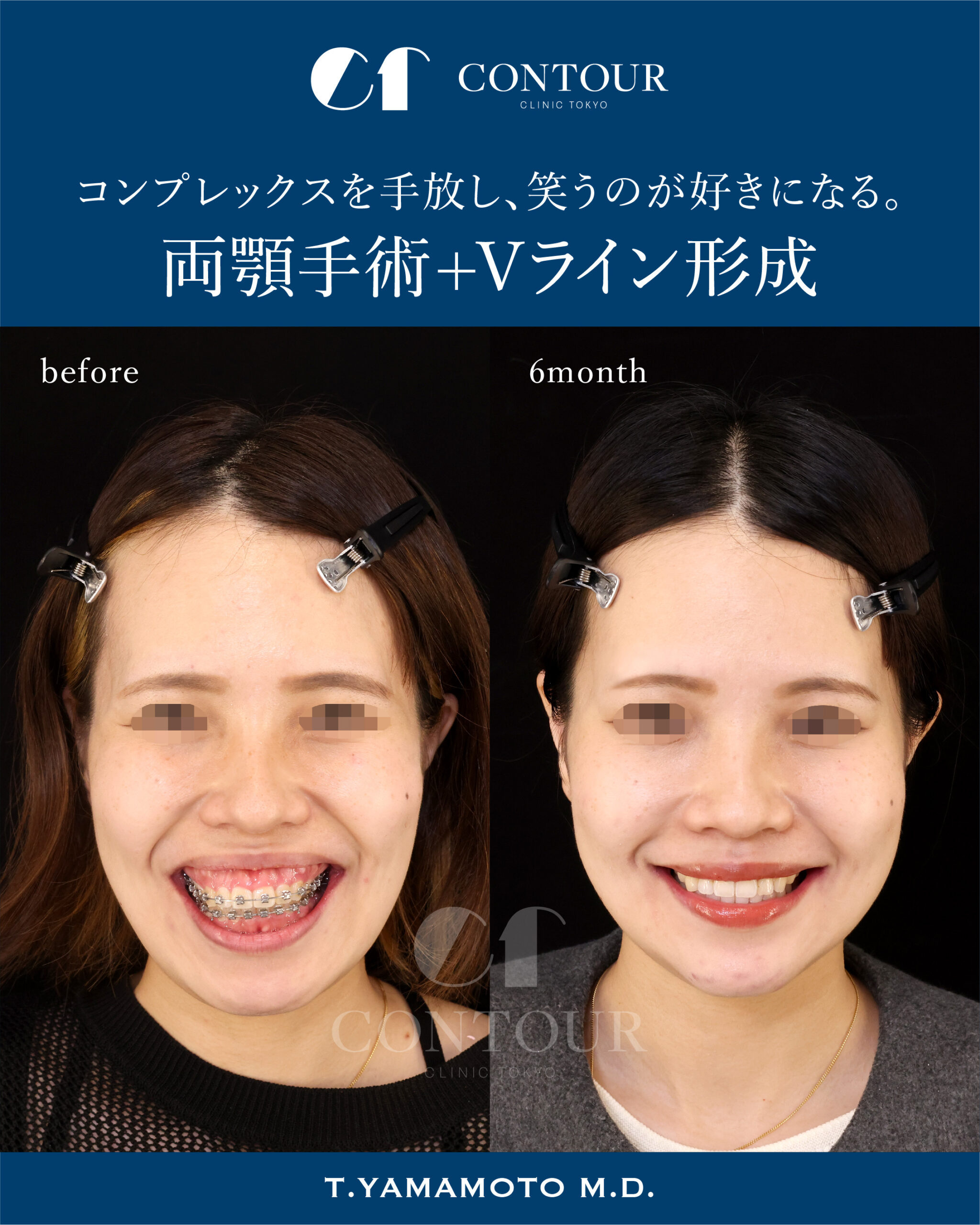 顔立ち劇変の裏に潜む代償とは？両顎手術の失敗リスクと保険の真相