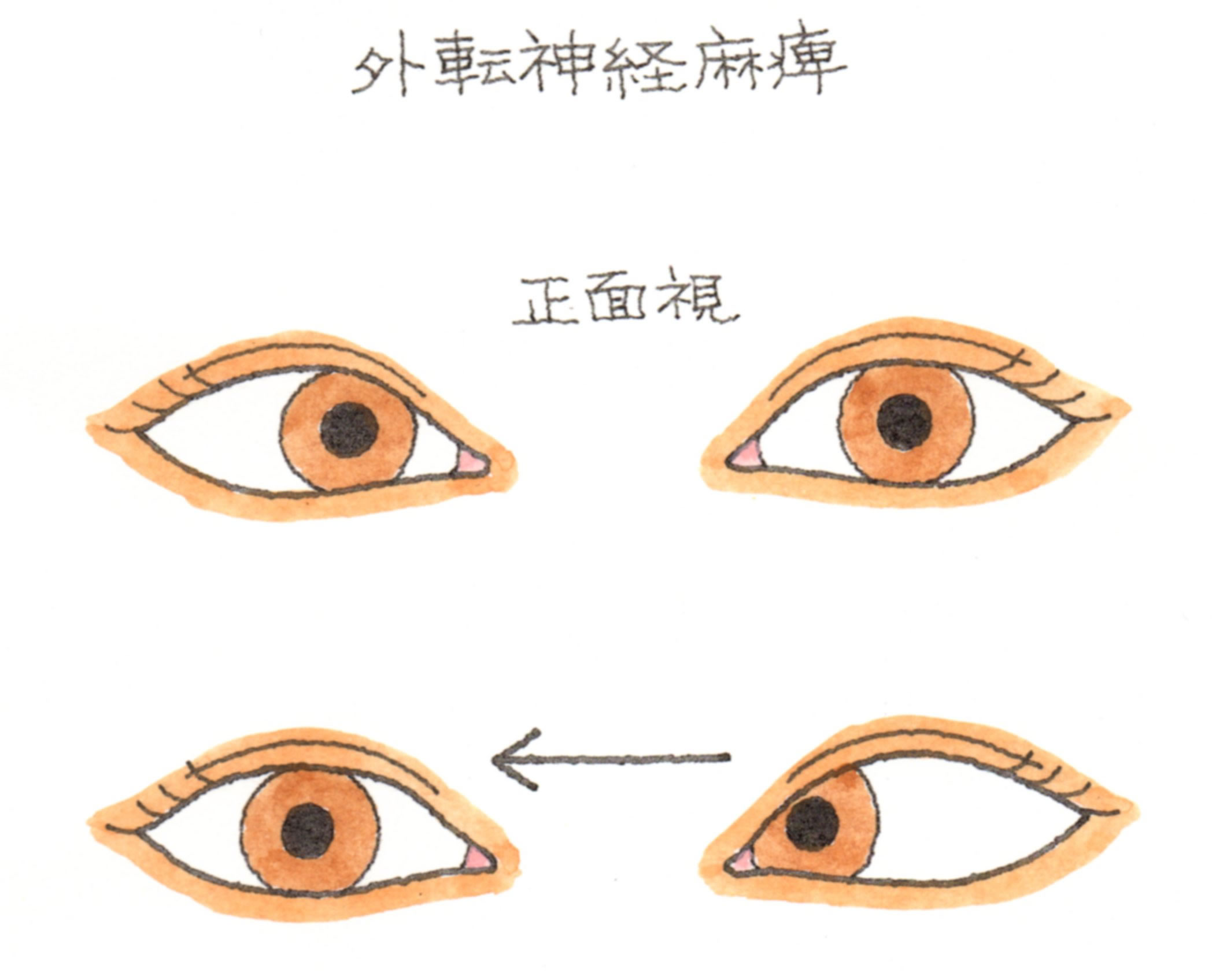 突然物が二重に見える外転神経麻痺の真実｜脳の病気や糖尿病リスクと治癒