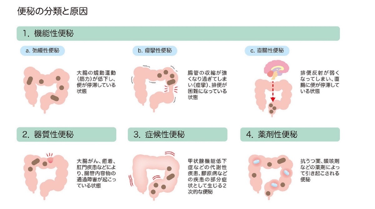 お腹が張って出ない？弛緩性便秘の原因とぜん動運動を取り戻す解消法