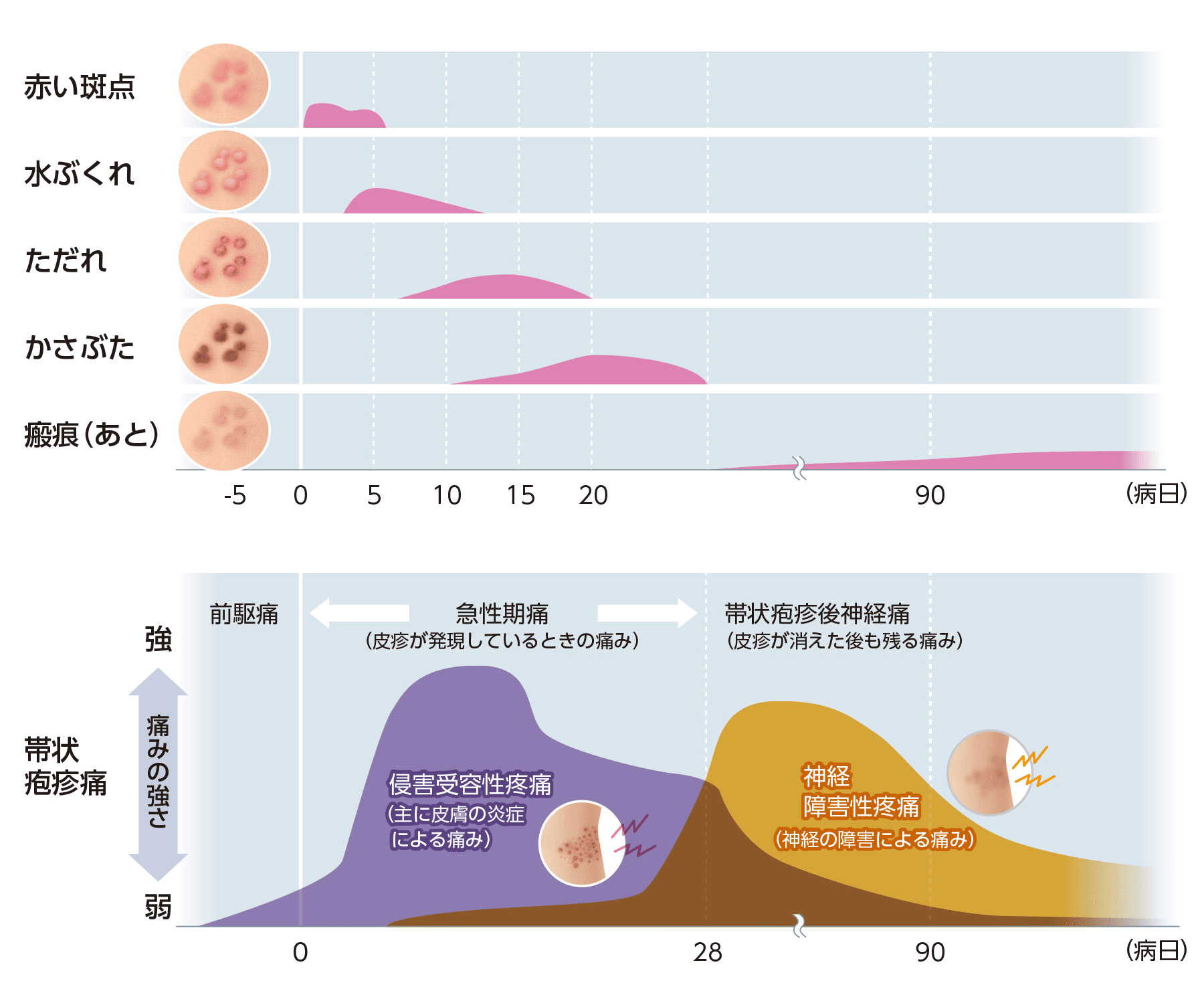帯状疱疹の痛みはいつまで続く？ピークの時期と長引く理由を徹底解明