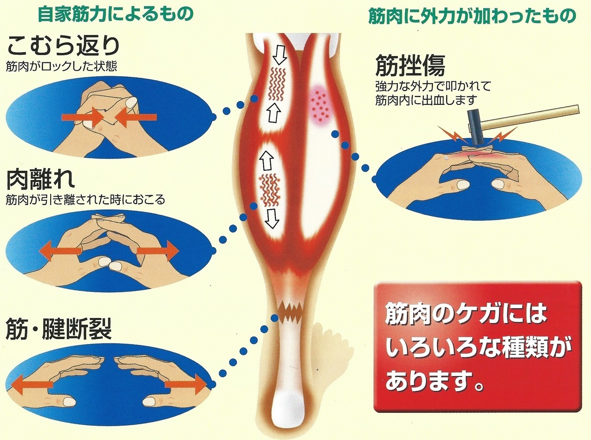 足がつるのと肉離れの違いは？激痛の原因と危険な見分け方を徹底解説
