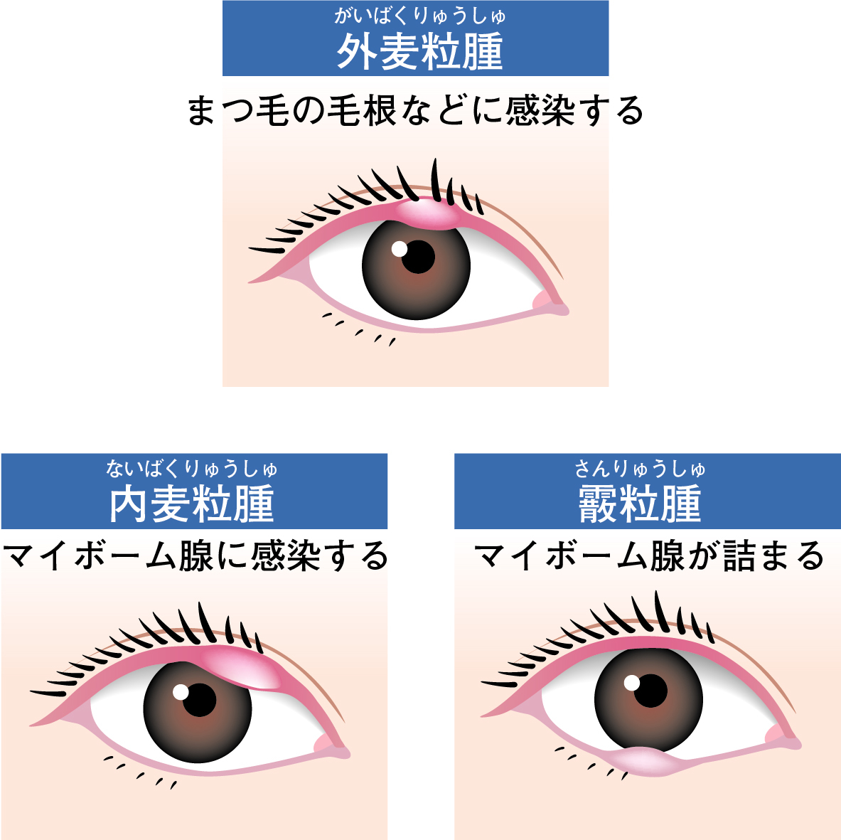 ものもらいとは？原因や人にうつる噂の真相・最速の治し方を徹底解説