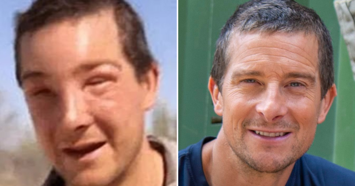 Bear Grylls Stung by a Bee
