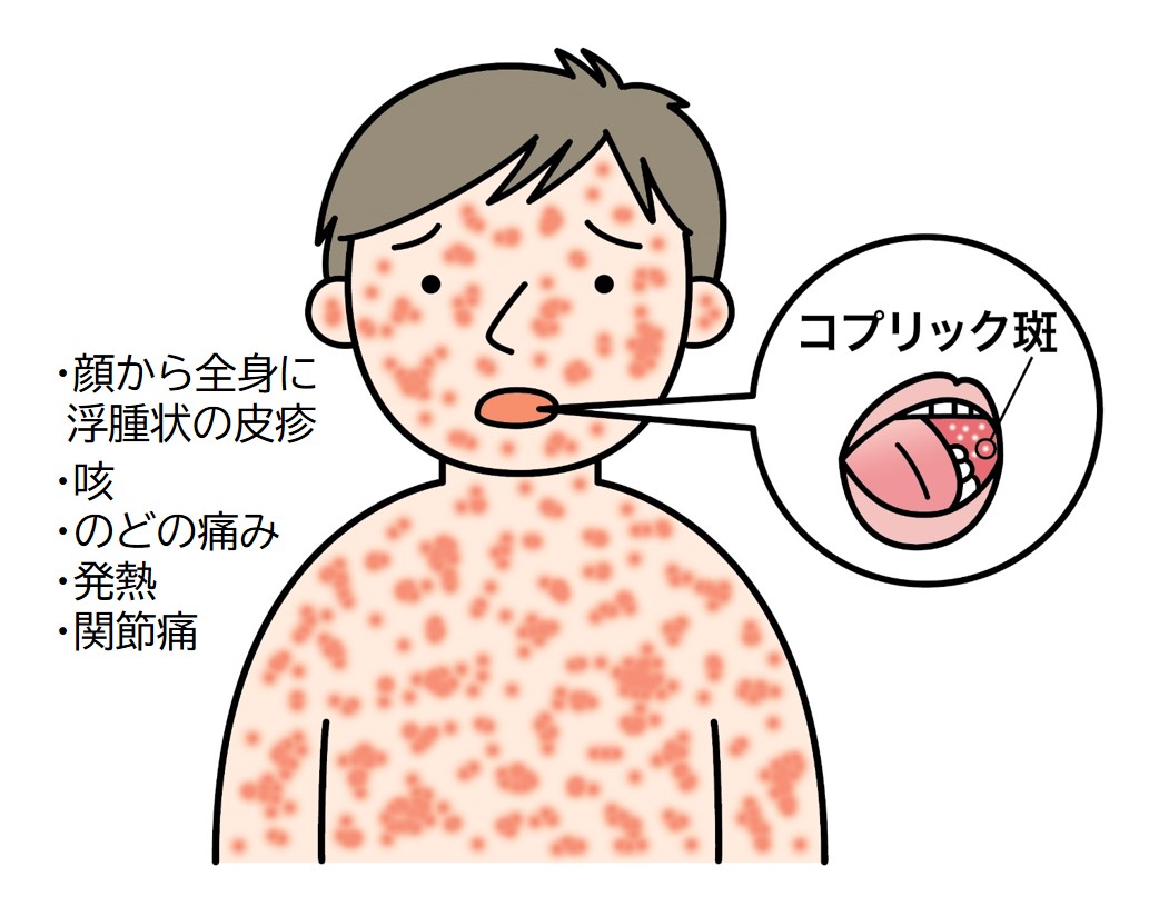 はしかとは？驚異の感染力と大人の重症化リスク・予防法総まとめ