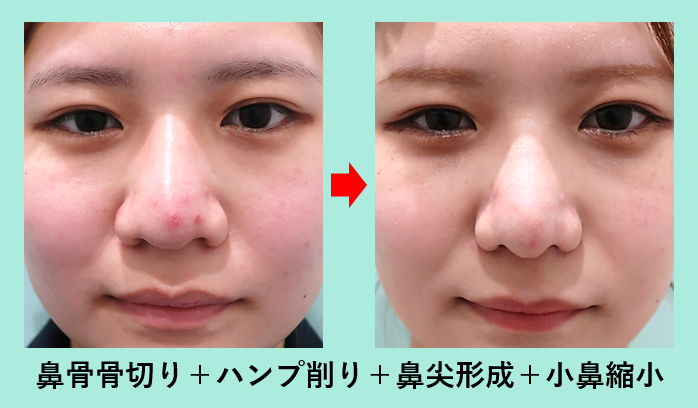 にんにく鼻に悩む男が激変！垢抜けを叶える最新の改善策と極意
