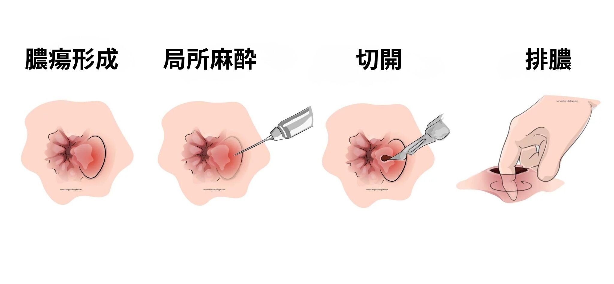 肛門周囲膿瘍の切開は痛い？局所麻酔が効かない真相と痛みのピーク