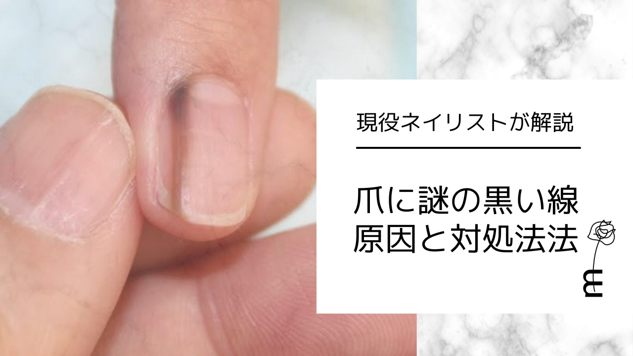 爪の黒い線は皮膚がんか？メラノーマの見分け方と危険な兆候【2026】