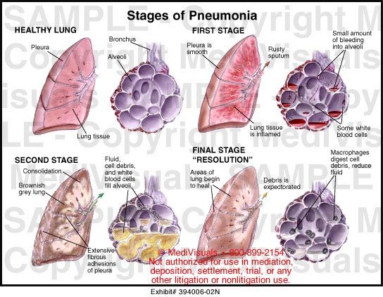 Last Stages of Pneumonia Before Death