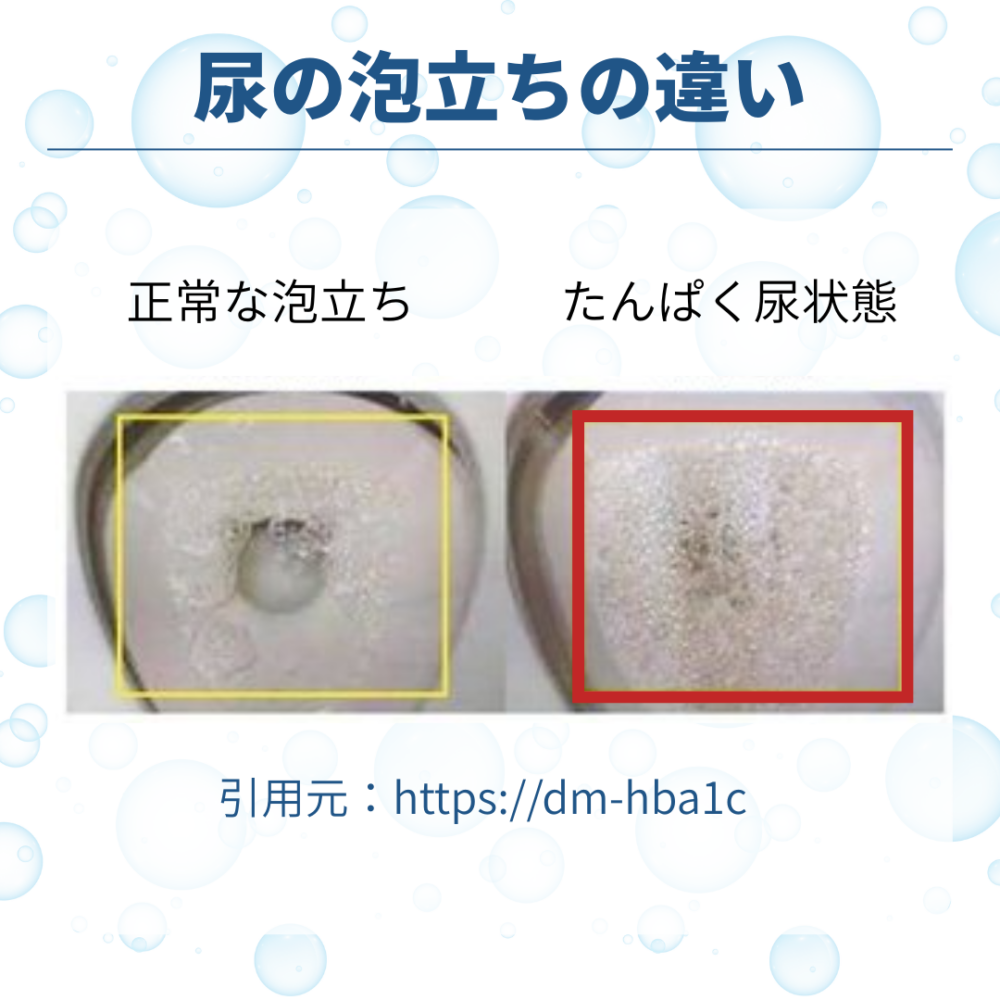 尿の泡や甘酸っぱい匂いは糖尿病のサイン？放置が招くリスクと最新判定
