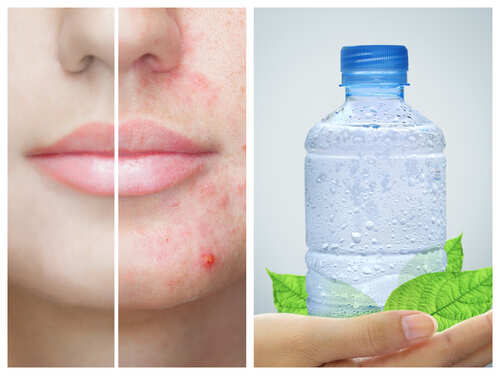 Does Water Get Rid of Pimples