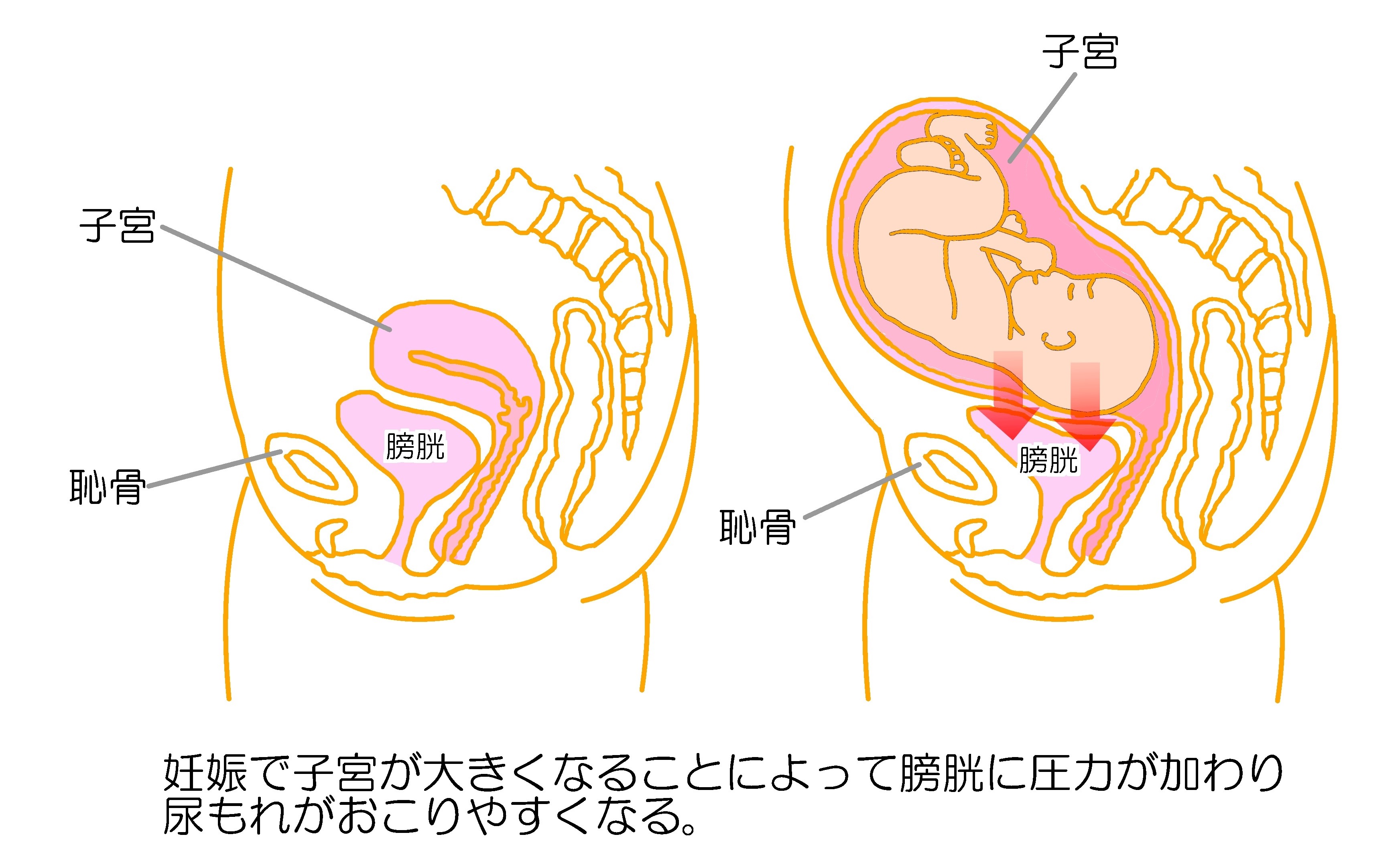 妊娠中の尿漏れ対策と破水の見分け方｜原因から予防法まで徹底解説