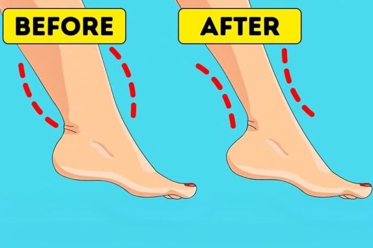 How Do I Get Rid of Cankles