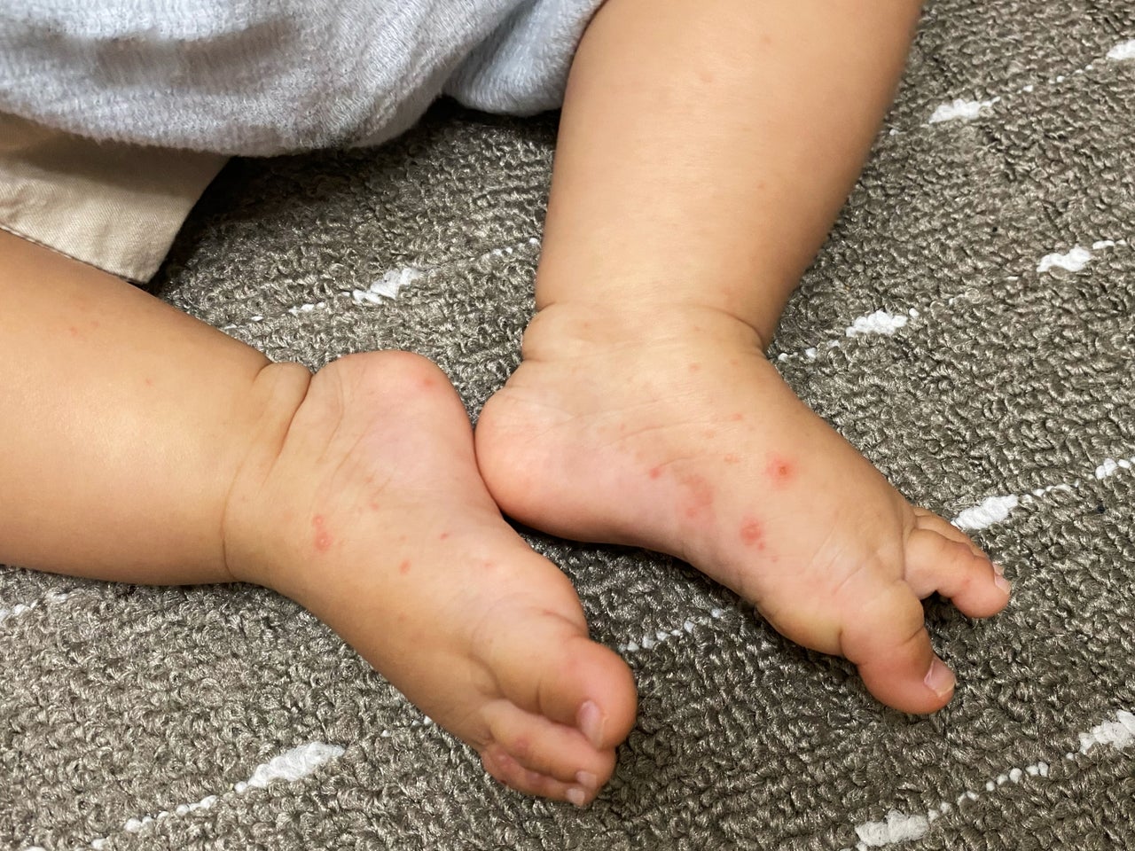 手足口病で足だけ発疹が出る謎｜手のひら・口内炎なしの原因と見分け方