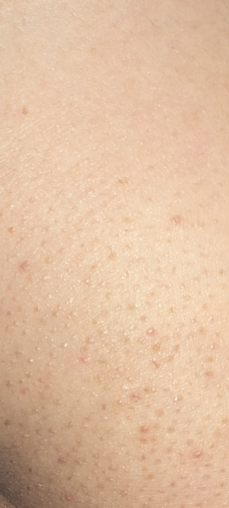 お尻のブツブツはなぜできる？毛嚢炎・粉瘤の見分け方と正しい治し方
