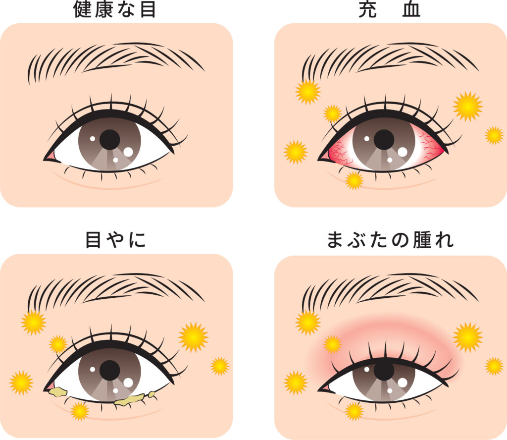 はやり目と結膜炎の違いとは？症状の見分け方と出勤停止基準を徹底解説