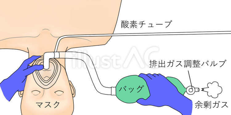 小児麻酔の必需品！ジャクソンリース回路の仕組みと安全な使い方
