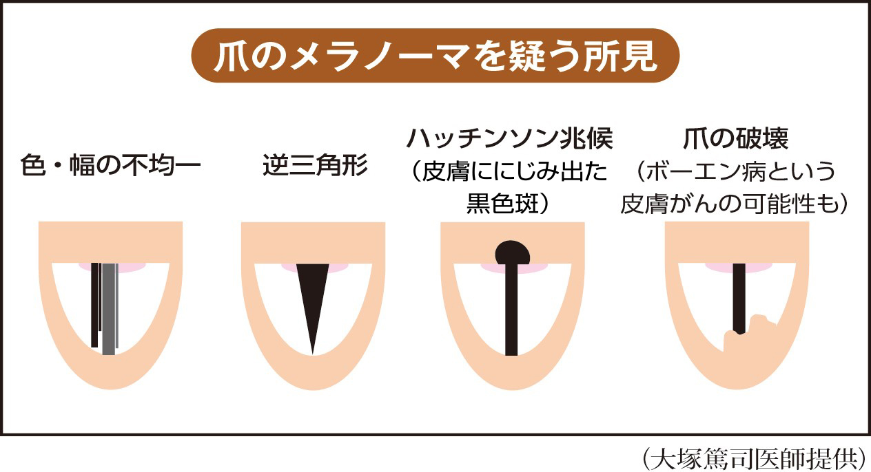 爪の中にほくろ？突然の黒い縦線とメラノーマの見分け方を徹底解説